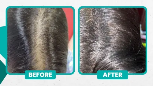 Best Treatment for Hair Loss and Regrowth